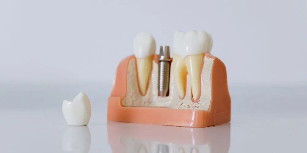 Implante dentário